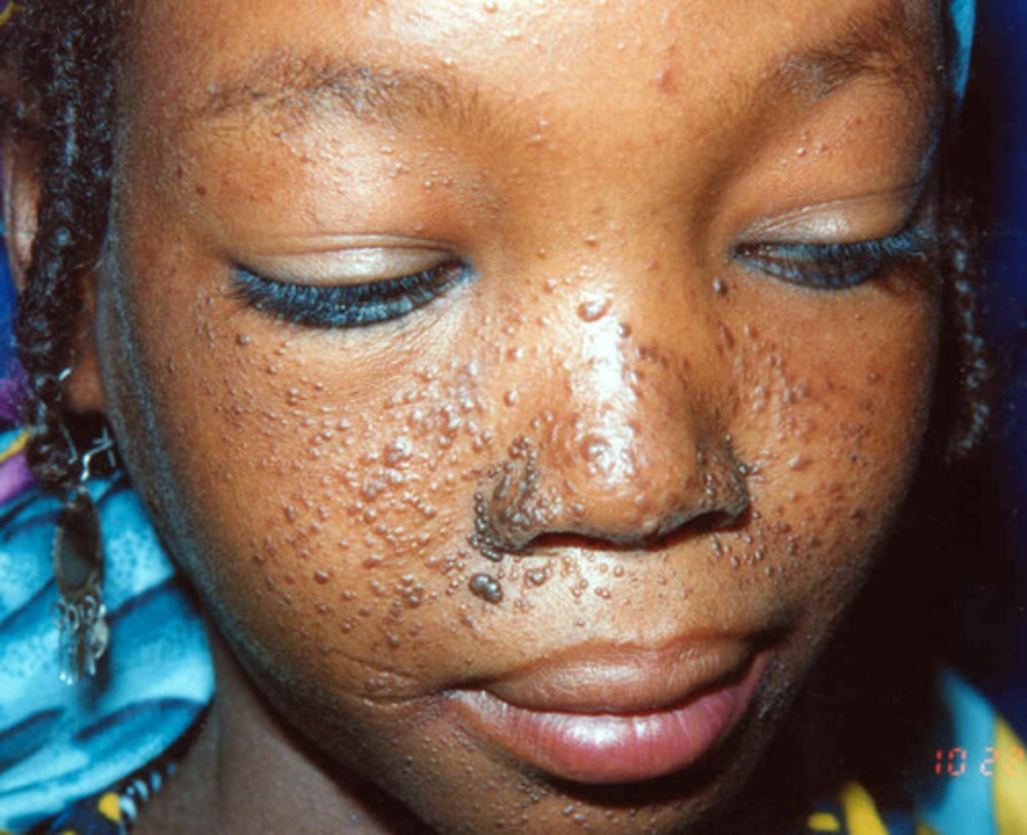 <p>TUBERCULOUS SCLEROSIS</p><p>Adenoma sebaceum occurs in about 90% of patients with tuberous sclerosis. A depigmented lesion, called a shagreen patch, occurs in only about 20% of these patients. Adenoma</p><p>sebaceum usually becomes apparent over the malar eminences of the face between 2 and 5 years of age and may evolve into difficult-to-treat angiofibromas of the skin.</p>