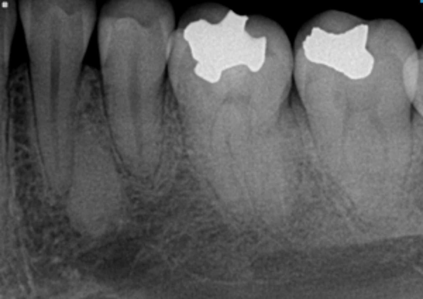 <p>What is the diagnosis?</p><p>Patient presents with a radiograph that has a well defined radiopaque lesion that seems to blend with trabeculae of surrounding bone. It has no affect on the adjacent teeth. This condition is contraindicated for ortho and implants due to decreased vascular supply in that region.</p>
