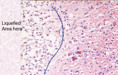 <p>subtype of lytic necrosis </p><p>end stage = fluid filled lesion. </p><p></p><p>final stages of necrosis in brain </p>