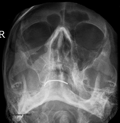 <p>Restricted upward eye motion from optic nerve entrapment.</p>