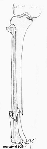 <p>What is a major concern with tibia/fibula fractures?</p>