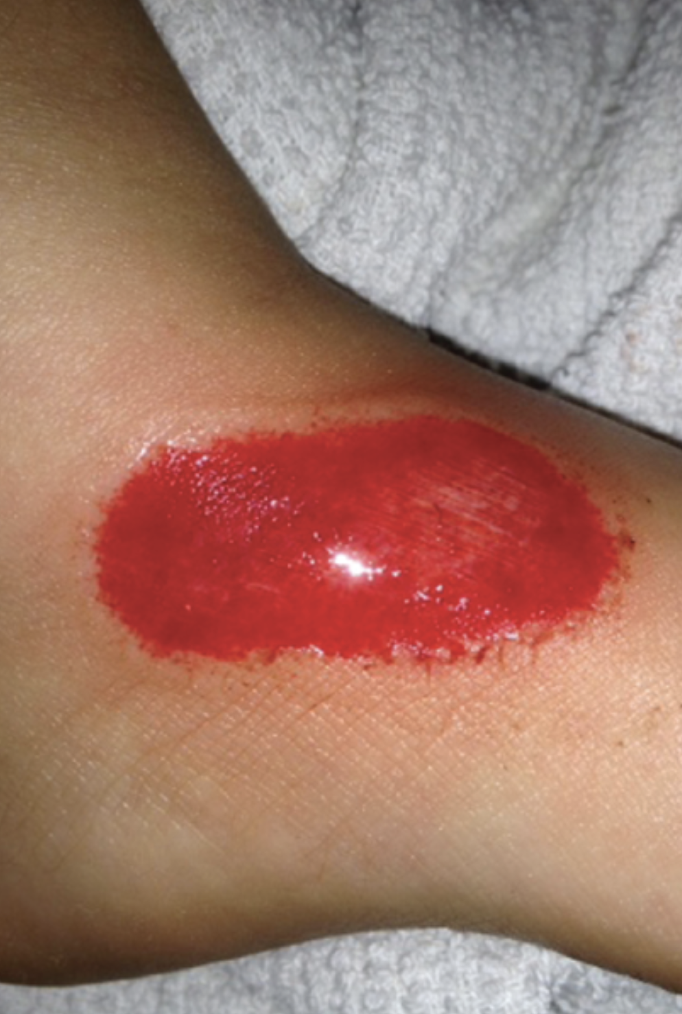what type of skin wound?