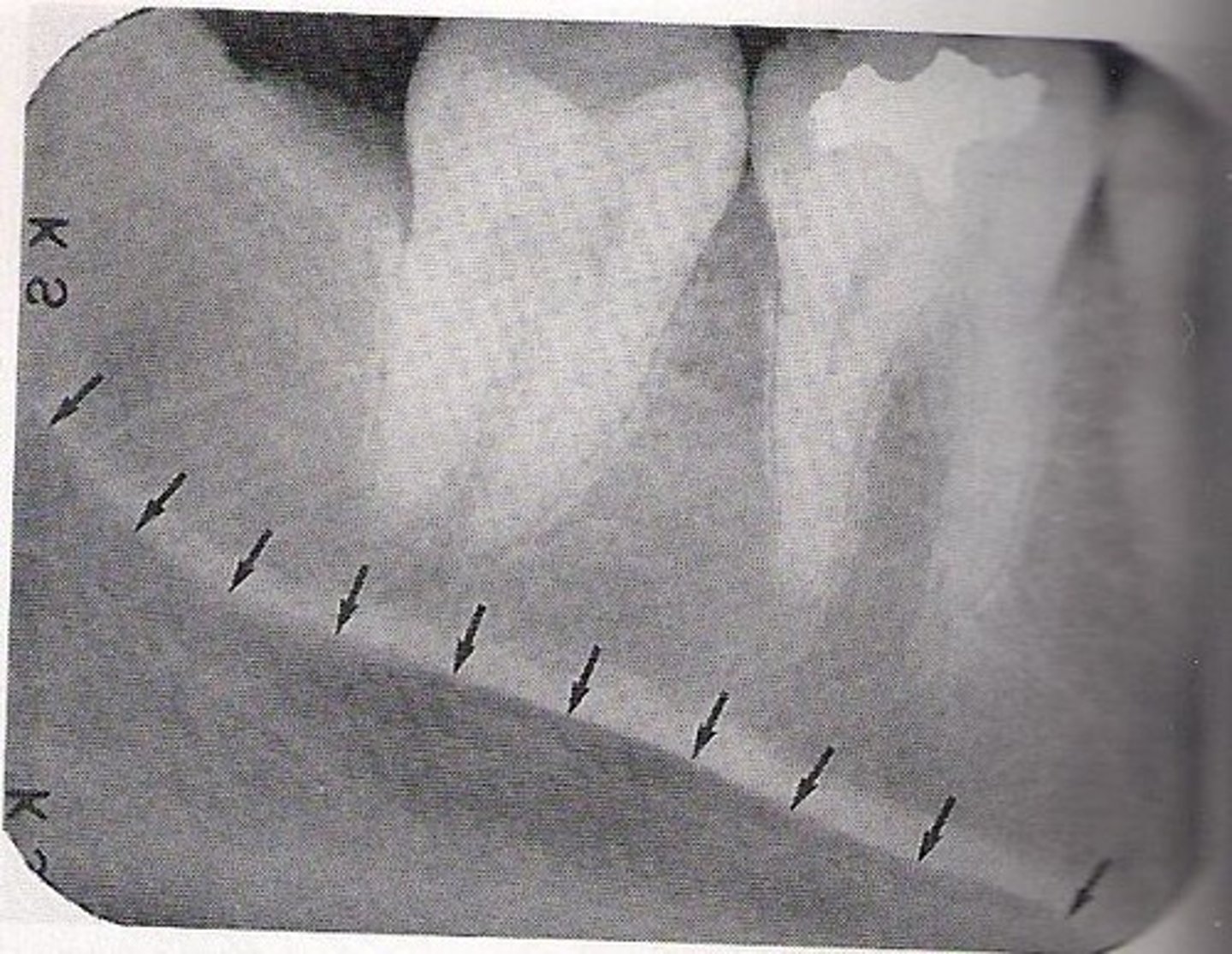 <p>below roots of mandibular molar</p>