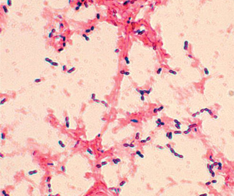 <p><span><span>One initial suspect bacteria you considered was the common otitis media bacterium </span><em><span>Haemophilus influenzae</span></em><span>. Why can we rule this organism out as the cause in the patient?</span></span></p>