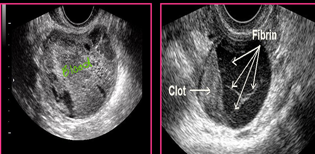 <p>A chronic hemorrhagic cyst appears _____ with _____ clotted blood and _____ level</p>