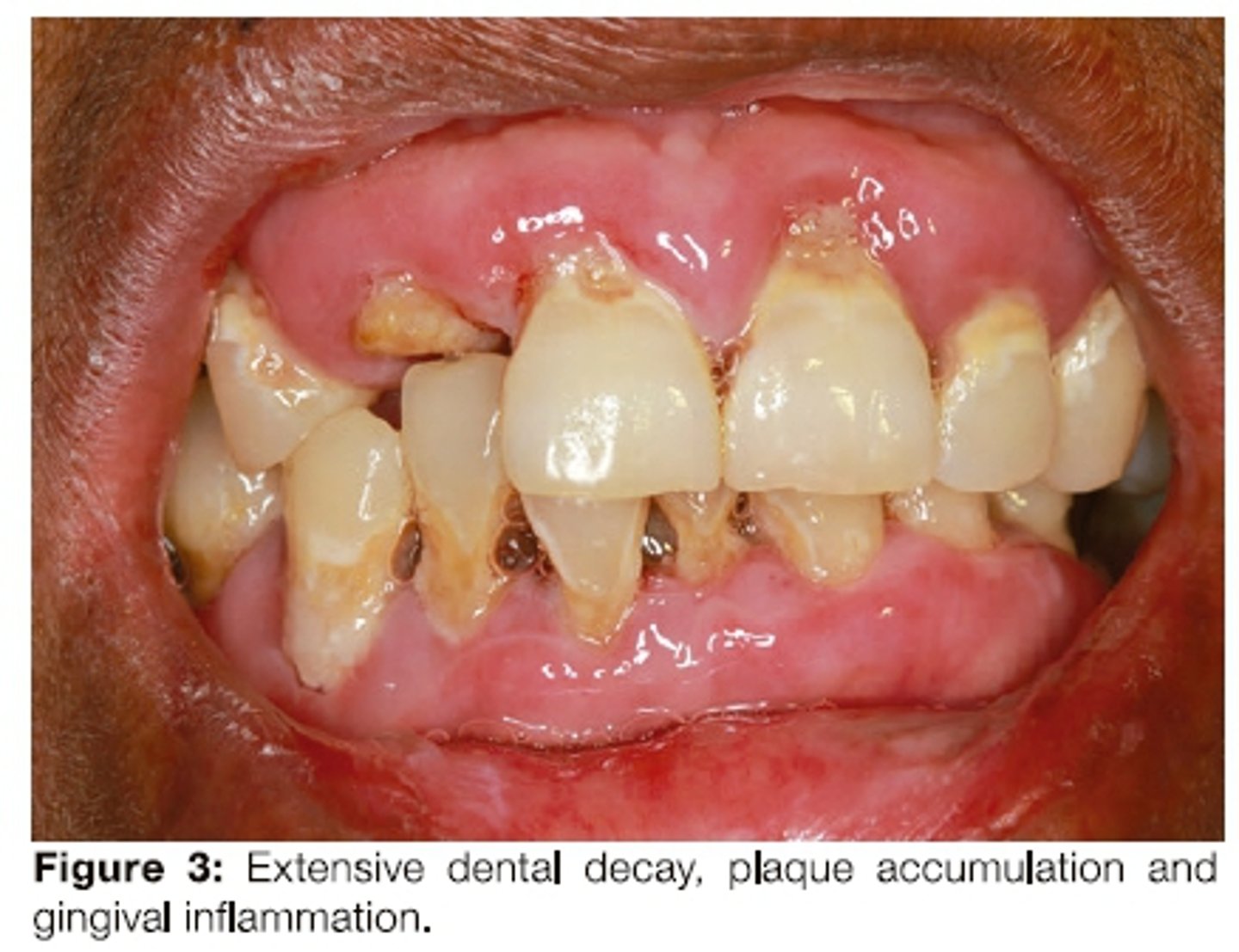 <p>A blistering condition presents in adulthood and is associated with autoantibodies. What is the MOST likely diagnosis?</p>
