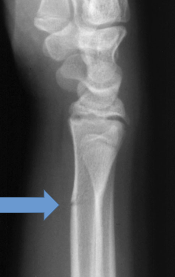 <p>What type of fracture is this? (Bonus points for full explanation)</p>