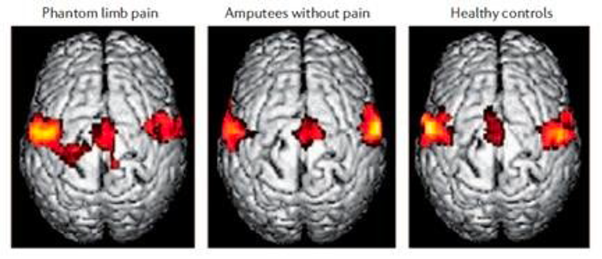 Cortical reorganization (changes happening centrally)