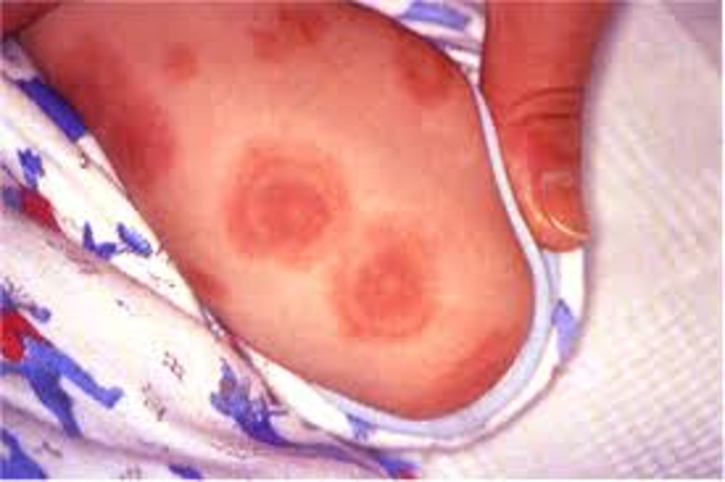 <p>-sharp margin, regular round shape, three concentric color zone</p><p>-center: dark red with blister or crust</p><p>-2nd ring: paler pink, raised due to edema</p><p>-outermost ring: bright red</p>