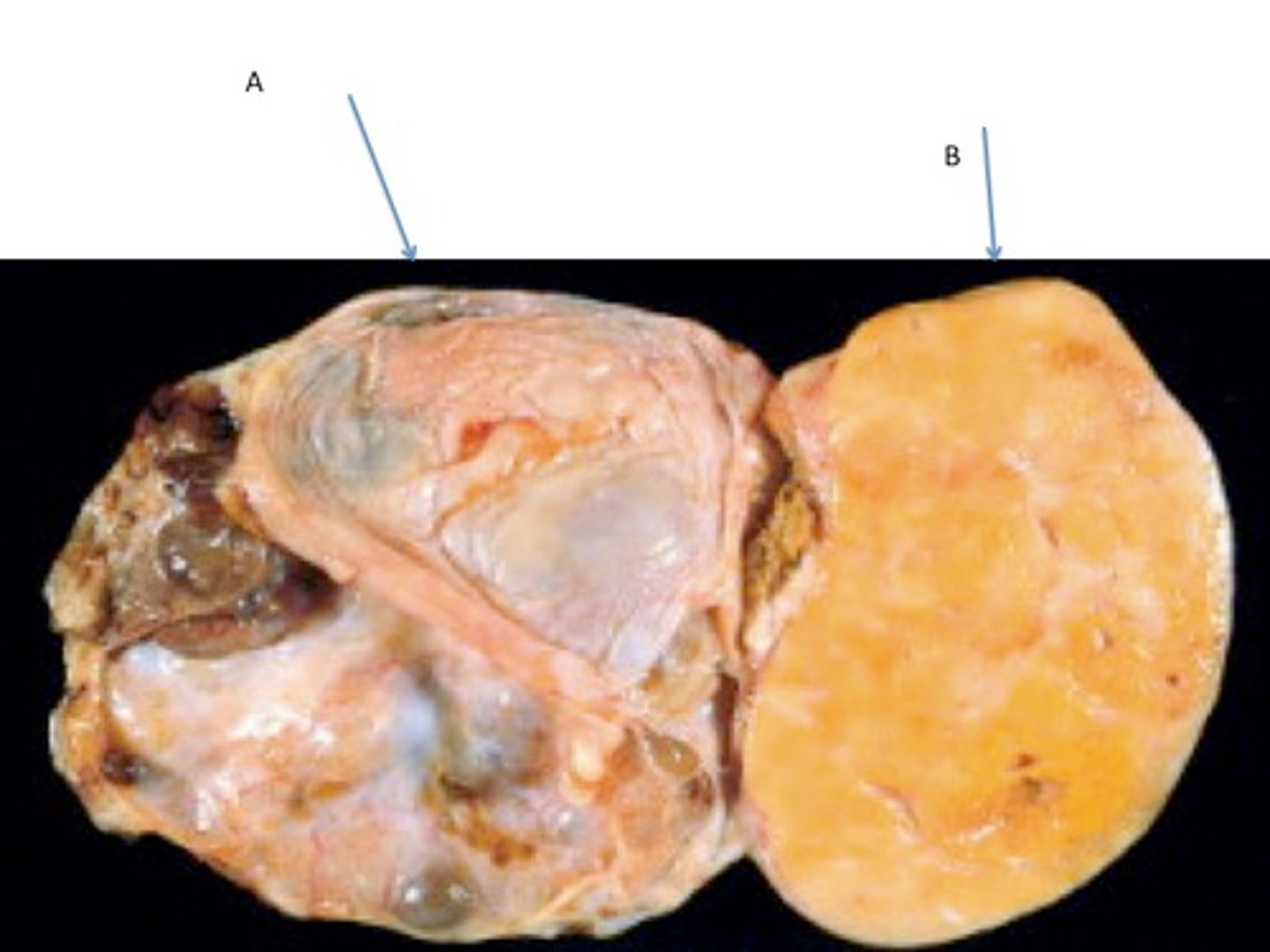 <p>Supportive tissue surrounding tumor cells.</p>