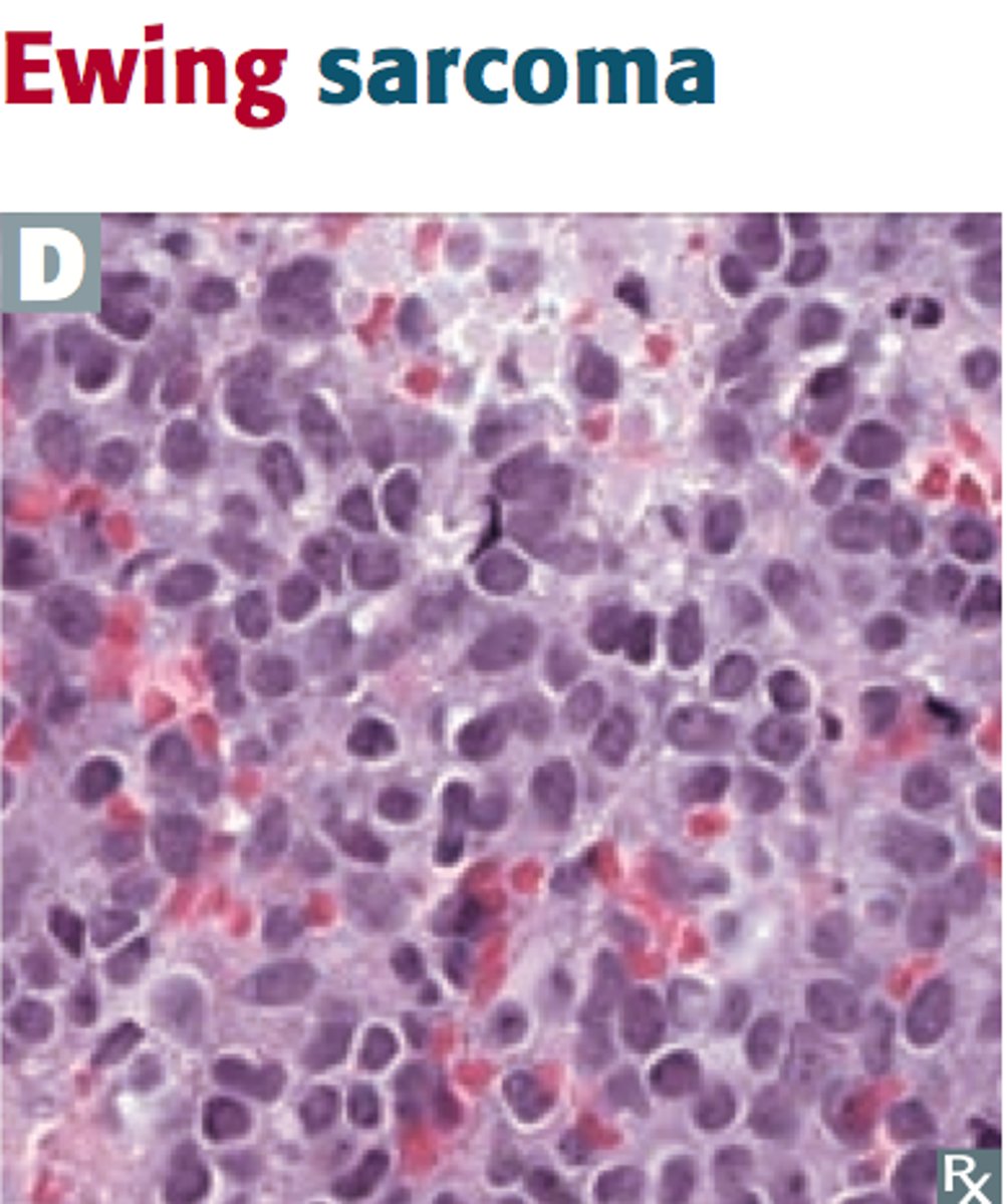 <p>tumor type: malignant bone tumor (primary)</p><p>epidemiology/location:</p><p>- boys < 15 yo</p><p>- commonly appears in diaphysis of long bones, pelvis, scapula and ribs</p><p>characteristics:</p><p>- anaplastic small blue cell malignant tumor</p><p>-extremely aggressive with early mets, but responsive to chemotherapy</p><p>- "onion skin" periosteal reaction in bone</p><p>- associated with t(11;22) translocation causing fusion protein (EWS-FLI 1)</p><p>-11 + 22 = 33 (Patrick EWING's jersey number)</p>