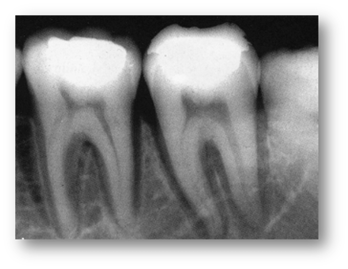 <p>Uniform widening of PDL space around the teeth is associated with what condition?</p>