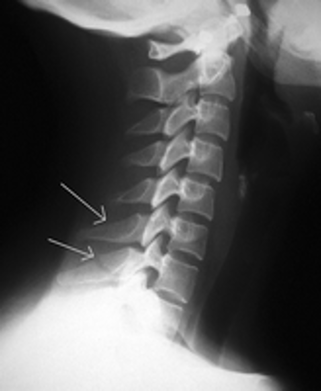 <p>fx of spinous process of C6, C7, T1, or T2</p><p>hyper flexion injury- reflex muscle pull on spinous process</p>