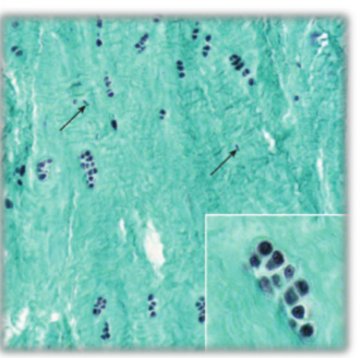 <p>Fibrocartilage</p><p>-type 1 &amp; 2 collagen</p><p>-no perichondrium</p><p>-intervertebral discs</p>
