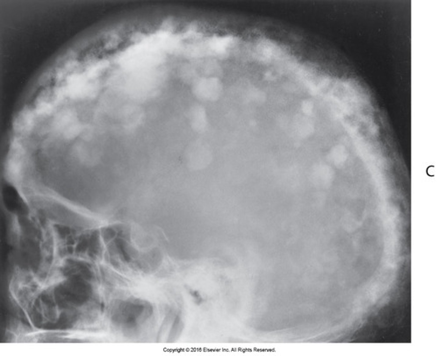 <p>Pagets disease</p>