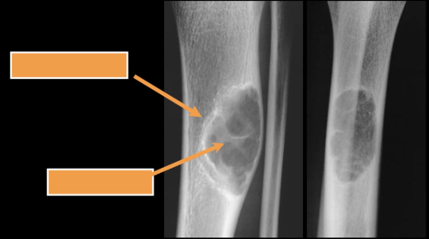 <p>ID radiographic feature of non-ossifying fibroma indicated by bottom arrow</p>