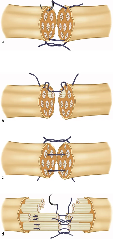 <p><span>•Decompression</span></p><p><span>•Direct repair</span></p><p><span>•Nerve graft</span></p><p><span>•Graft comes from self, cadaveric tissue</span></p><p><span>•Bioartificial conduit</span></p><p><span>•Nerve Transfer</span></p><p><span>•</span></p><p><span>•Tendon transfers when nerve is not successfully repaired.</span></p>