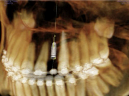 <p>what is this showing for the CBCT</p>