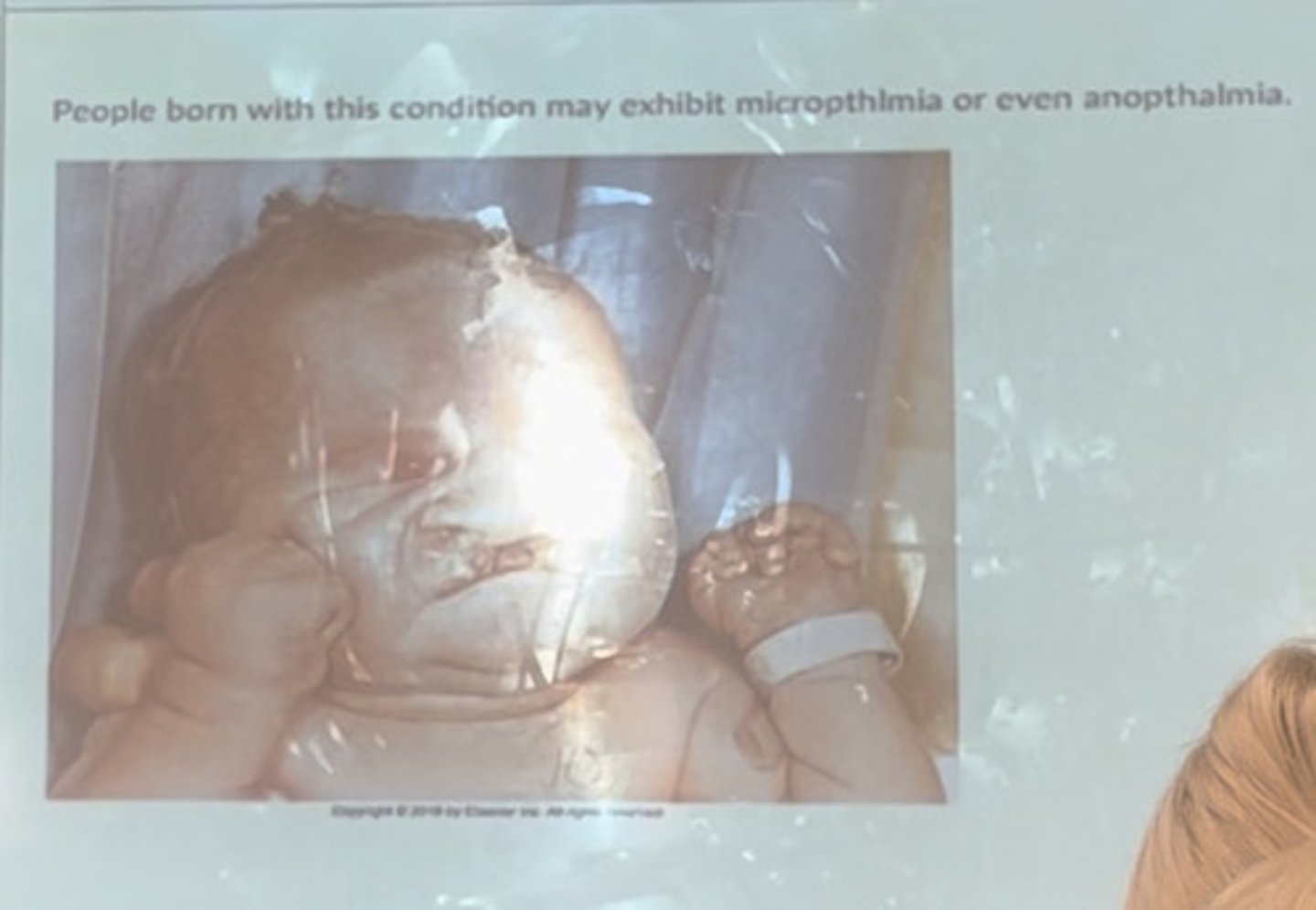 <p>People born with this condition may exhibit micropthalmia (baby's eyes are small) or even anopthalmia (born w/out one or both eyes)</p>