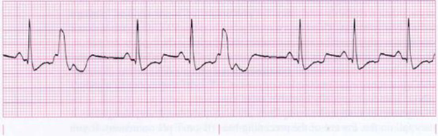 <p>-most common ventricular arrhythmia</p><p>-typically occur randomly </p><p>-origin: ventricular myocardium</p><p>-wide abnormal QRS (&gt;0.12s)</p><p>-no P waves, sometimes retrograde </p><p>-usually followed by prolonged compensatory pause before next beat (&gt;3 is considered VT)</p>