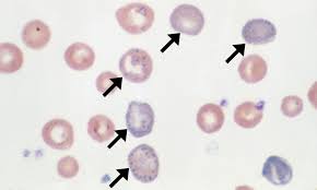 <p>represents the spontaneous aggregation of ribosomal rna in the cytoplasm of erythrocytes</p>