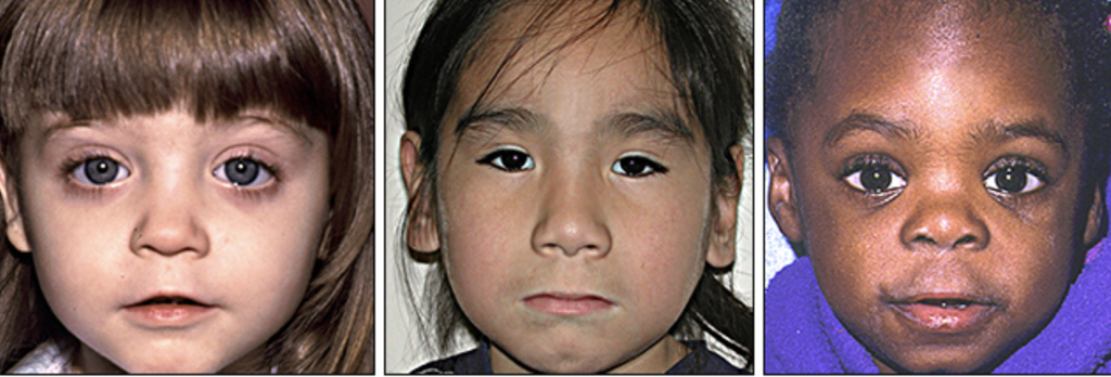 <p>Growth retardation, CNS dysfunction, mental deficiency, emotional disorders, &amp; characteristic facial dysmorphology such as short palpebral fissure length, smooth philtrum, &amp; thin upper lip</p>