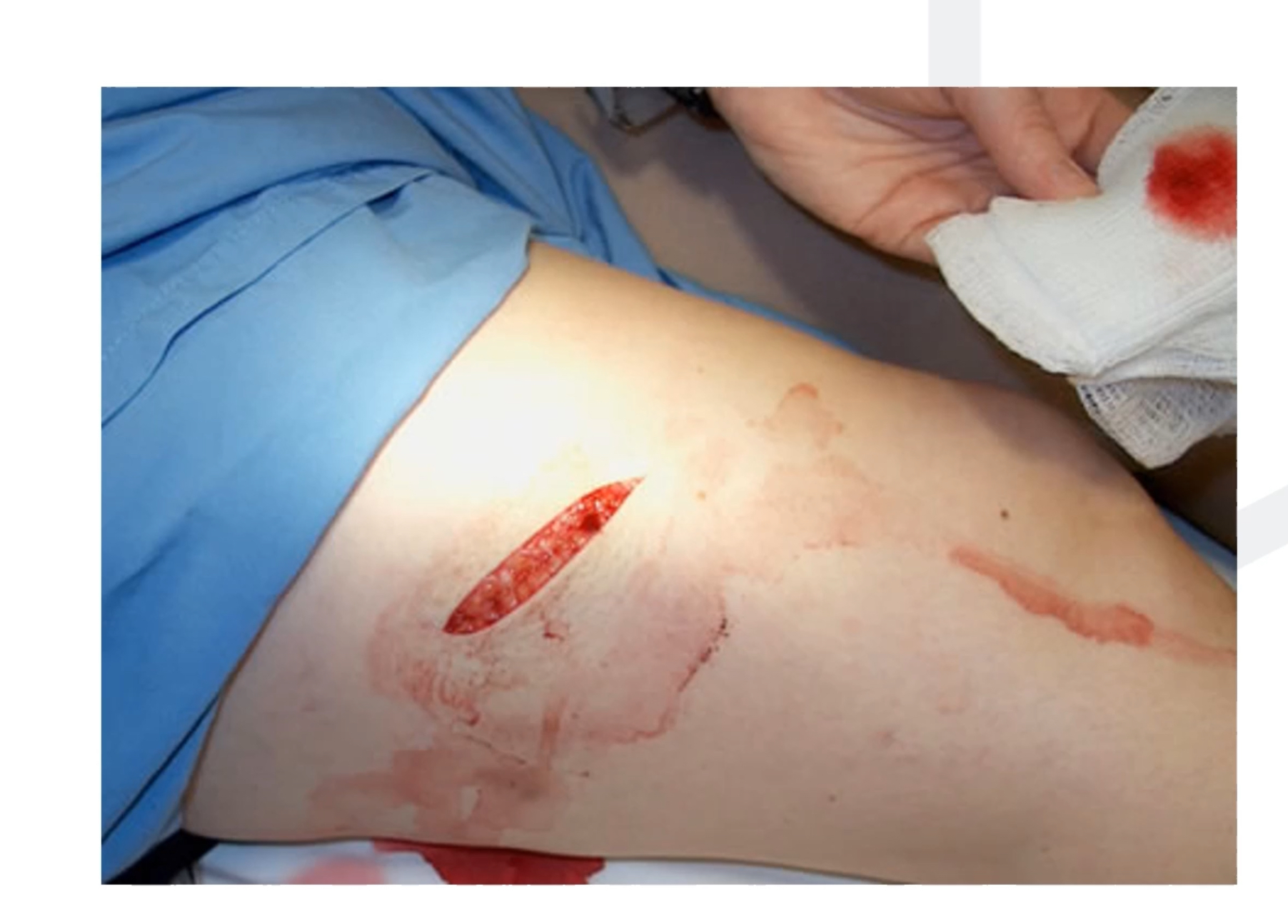 <p>Surface of skin is torn and can be down to subcutaneous tissue, clean, neat wounds, may be due to being caught on something, heal nicely if treated properly </p>