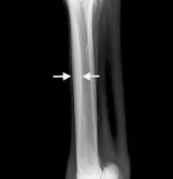 <p><span style="background-color: transparent;"><strong><span>Bucked Shins</span></strong></span></p>