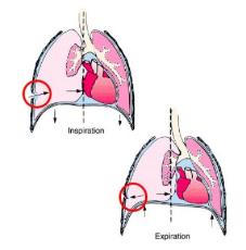 <p>Penetrating trauma makes a hole in the chest wall, allowing air to be drawn into the thoracic cavity when the patient breathes in, and sealing shut when the patient breathes out. Every time the patient breathes in, more air enters, collapsing the lung and increasing the pressure inside.</p>