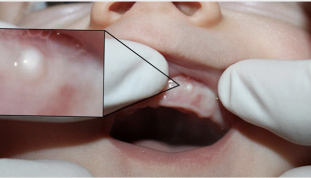 <p><span style="color: #000000">Occur along the buccal and lingual aspects of the alveolar ridge</span></p>