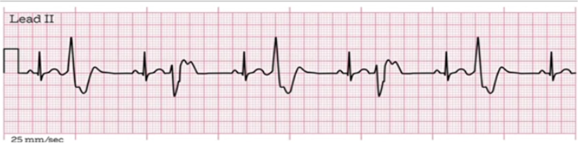 <p>What does this EKG represent?</p>