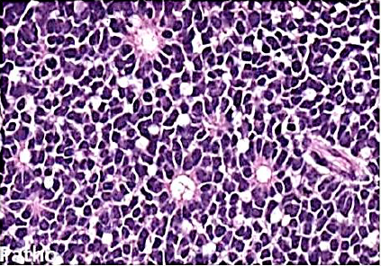 <p>Retinoblastoma</p><p>M/P: The tumor is formed of undifferentiated retinal cells; that show characteristic rosettes which is of 2 types:</p><p>1.Flexner-Wintersteiner rosettes (around a lumen). <strong>in this picture</strong>.</p><p>2.Homer-Wright rosettes (around neuri-fibrillary structure).</p>