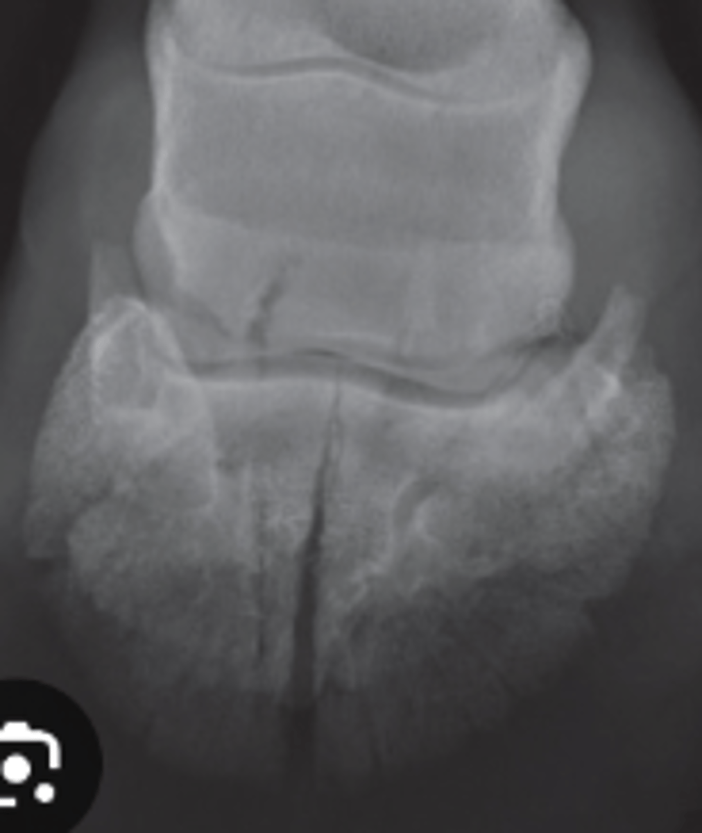 <p>What fracture type is this?</p>