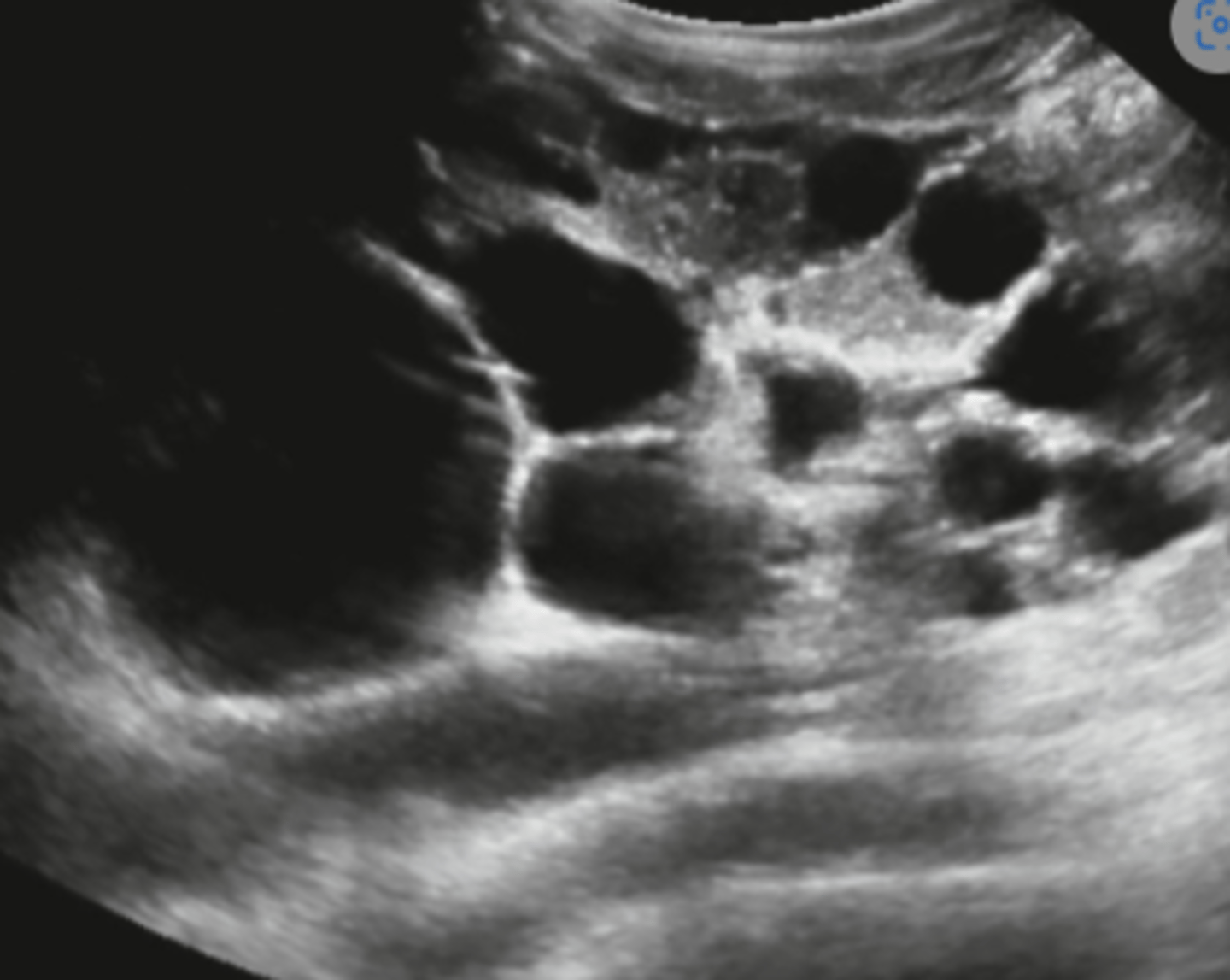 <p>Autosomal dominant polycystic kidney disease</p>
