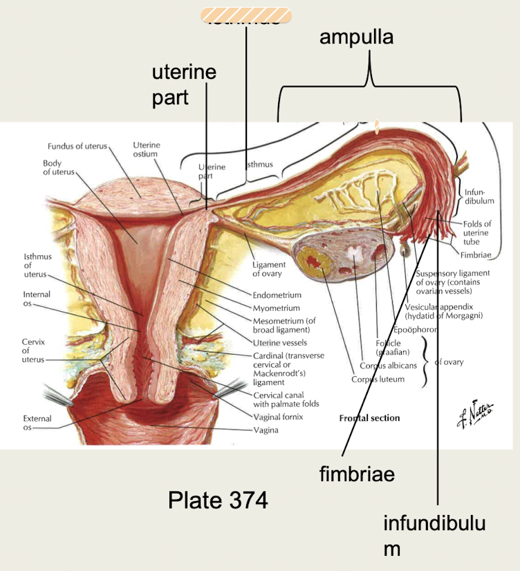 <p>Narrowing of uterine tube</p>