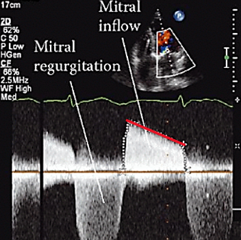 <p>time it takes for peak P to drop to half og P</p><ul><li><p>stenosis or regurgitation</p></li></ul><p></p>