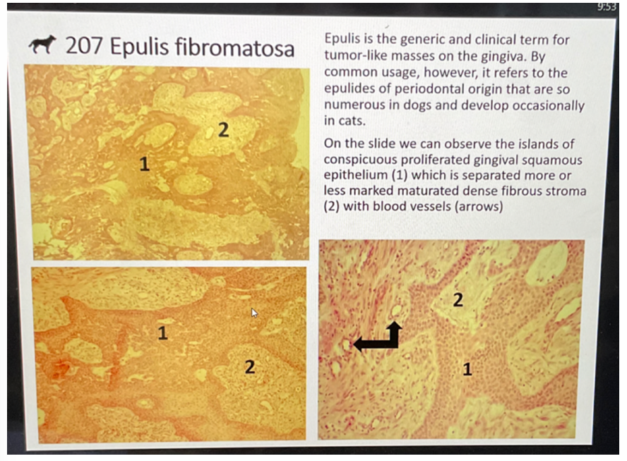 <p><strong>epulis fibromatosa</strong></p>