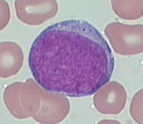 <p>High N:C ratio of 8:1 to 4:1. Basophilic cytoplasm with fine nuclear chromatin. 2 to 4 visible nucleoli. No visible granules or the presence of a few dispersed primary (azurophilic) granules in the cytoplasm</p>
