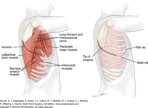 <ul><li><p class=""><strong>Incision:</strong> From back (posterior axillary line),</p><ul><li><p class="">around to the front of the chest</p></li></ul></li><li><p class="">Involves cutting through the <strong>latissimus dorsi</strong> and <strong>intercostal muscles</strong></p></li><li><p class=""><strong>Access:</strong> One side of the thoracic cavity (excellent view of <strong>lung, oesophagus, aorta</strong>)</p></li><li><p class=""><strong>Used for:</strong></p><ul><li><p class=""><strong>Lobectomy</strong></p></li><li><p class="">Pneumonectomy</p></li><li><p class="">Esophageal surgery</p></li></ul></li></ul><img src="https://knowt-user-attachments.s3.amazonaws.com/0a1786ee-c747-4088-8ef8-310612e5fb6b.png" data-width="50%" data-align="center" alt="knowt flashcard image"><p></p>