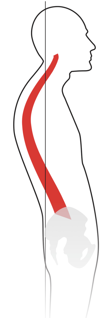 <p>hypolordosis</p>