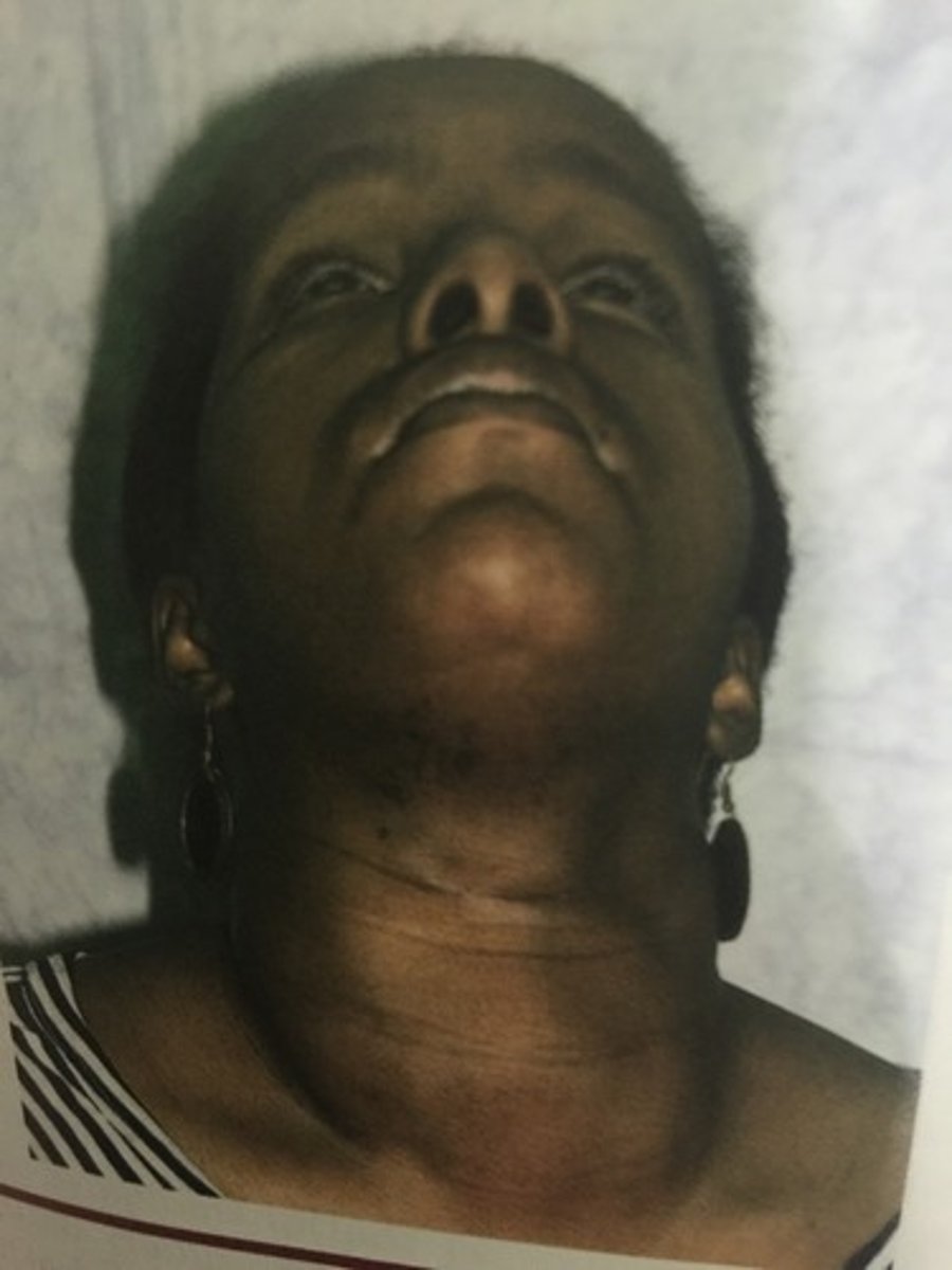 <p>nodular enlargement of the thyroid associated with hyperthyroidism</p>