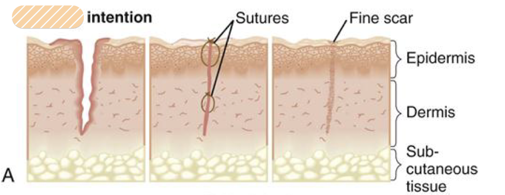 <p>What form of healing occurs <strong>when tissue is cleanly incised and anatomically re-approximated</strong>, healing usually proceeds without disruption or complication? </p>