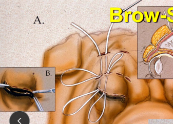 <p><span style="background-color: transparent;"><strong><span>Advanced Cosmetic Surgical Eyelid Procedures</span></strong></span></p>