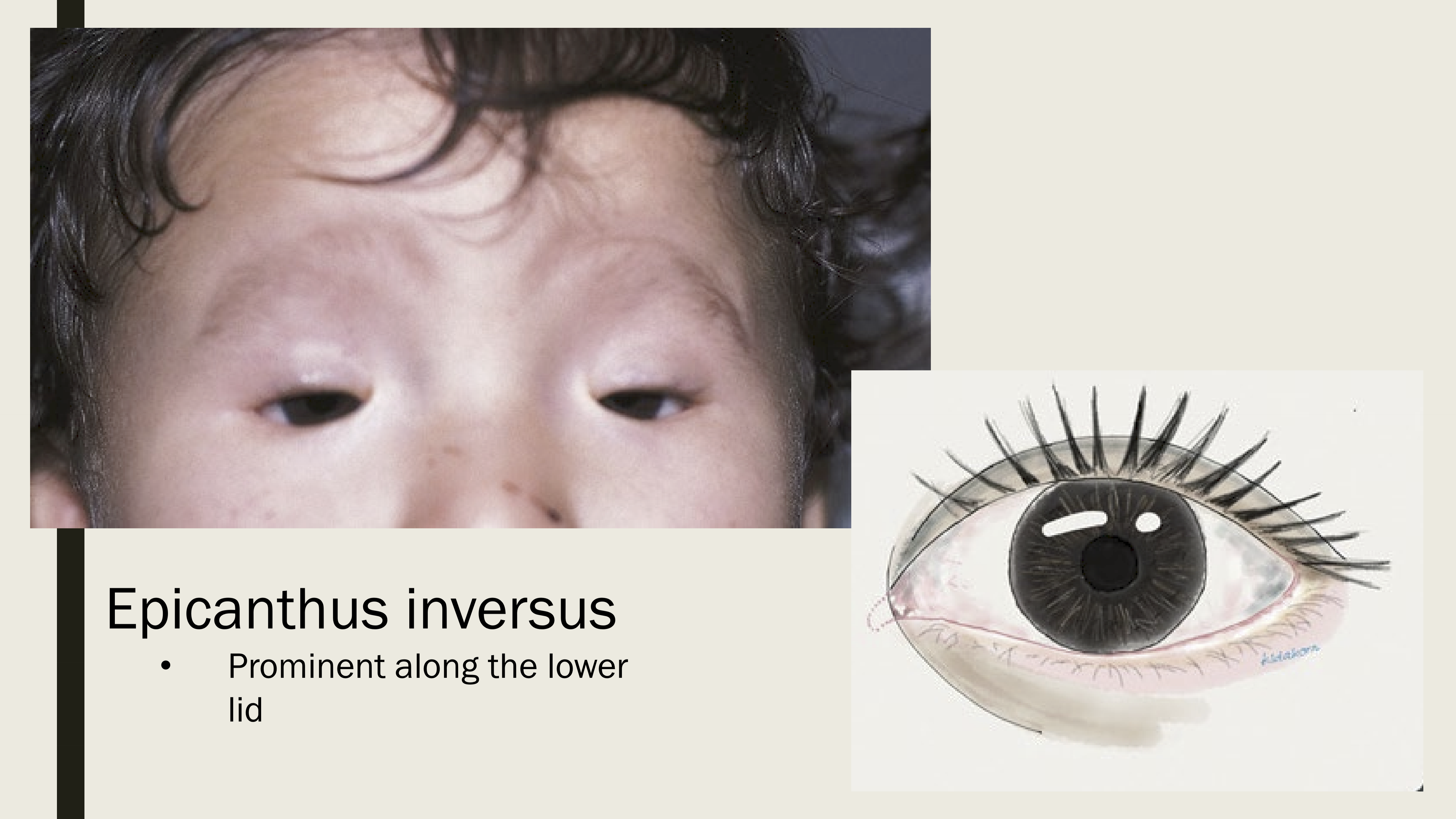 <p>Prominent skin along lower lid. </p>