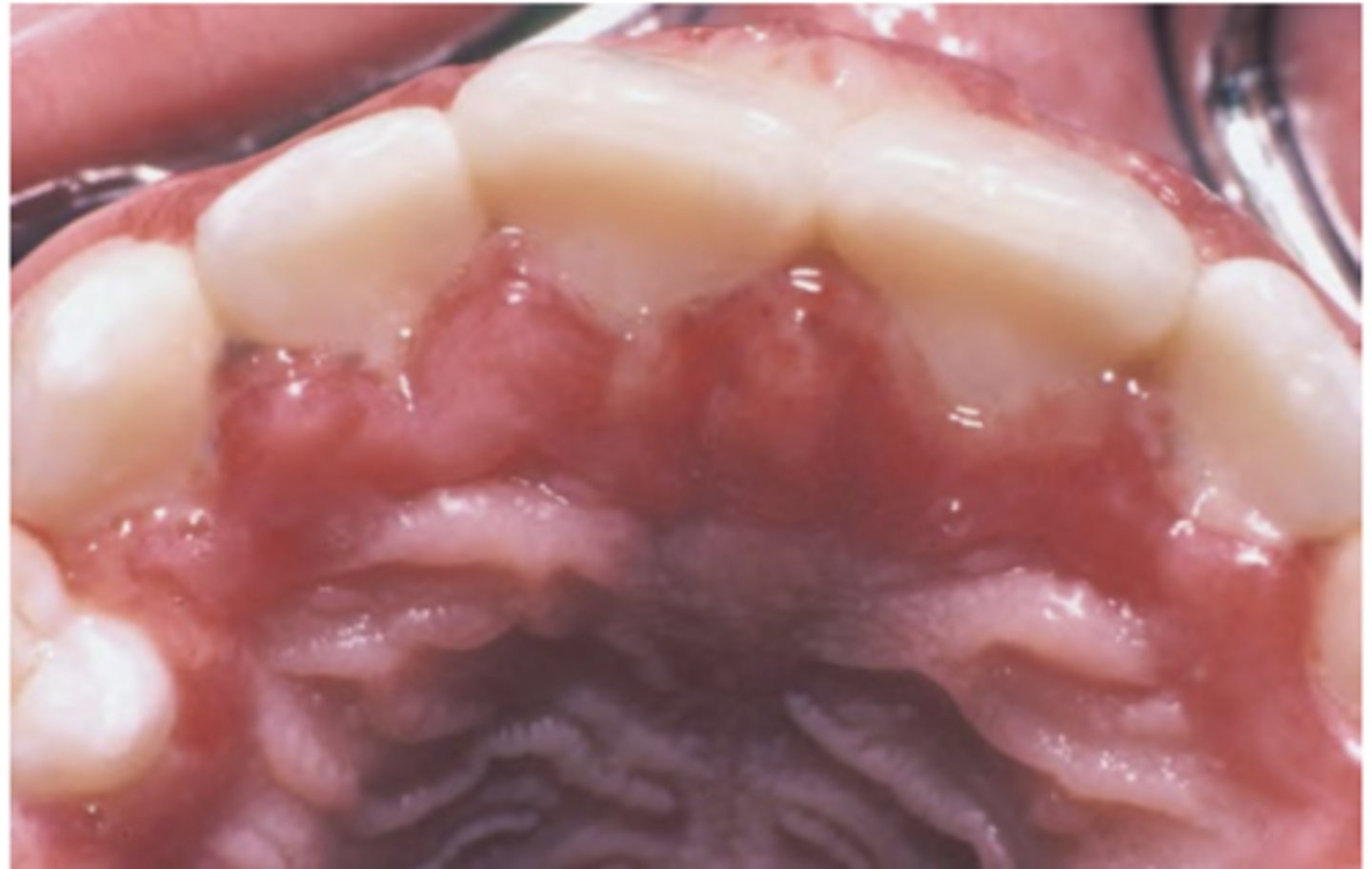 <p>Hint: occurs in young children on mouth/lips; painful enlarged erythematous palatal gingiva</p>