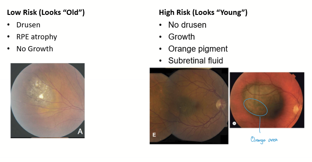 <p>Nevus: low risk, drusen, RPE atrophy, no growth</p><p>Uveal melanoma: high risk, looks young, no drusen, growth, orange pigment, subretinal fluid. </p>