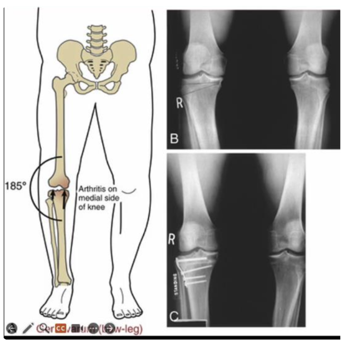 <p>Deformity →</p><p><strong>increased medial joint loading →</strong></p><p>greater loss of joint space → </p><p>greater tibial adduction → </p><p><strong>increased strain on LCL → </strong></p><p>increased medial joint load</p>