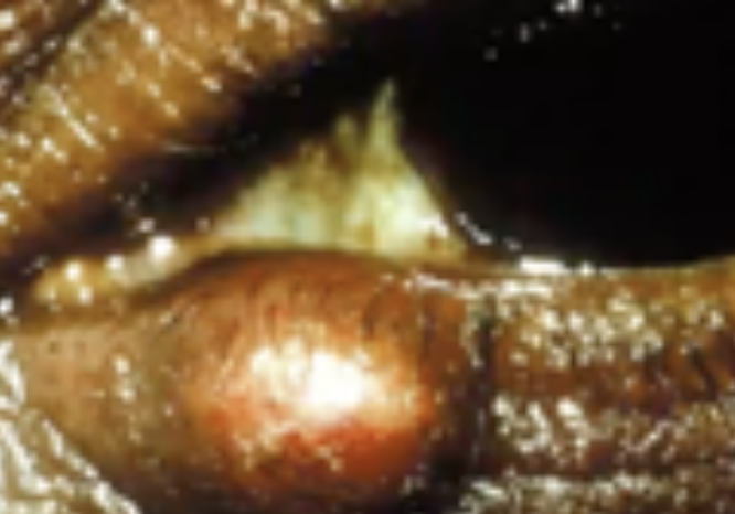 <p>Abnormalities of the External Eye</p><ul><li><p>Stye</p></li></ul><p></p>