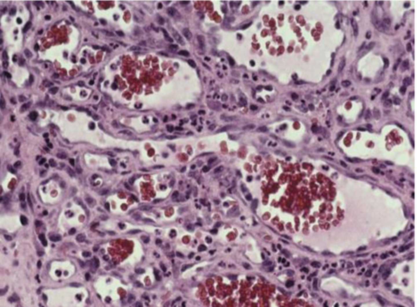 <p>• Ulcerated stratified squamous epithelium</p><p>• Vascularized fibrous connective tissue</p><p>• Mixed inflammatory infiltrate</p>