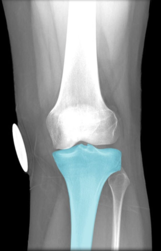 Description:
Long bone between knee and ankle
joints
Characteristic features include medial
and lateral condyles, medial and lateral
plateaus, tuberosity, shaft, and medial
malleolus
Contributes to knee and ankle joints